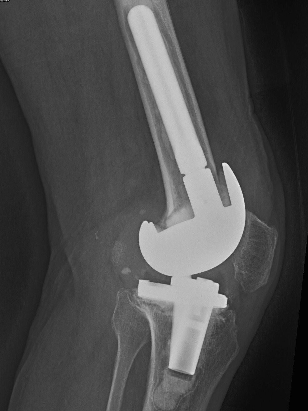 Revision TKR Deficient Metaphysis Lateral